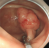 有茎性、亜有茎性ポリープの切除方法