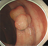 有茎性、亜有茎性ポリープの切除方法