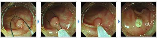 有茎性、亜有茎性ポリープの切除方法