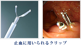止血に用いられるクリップの写真