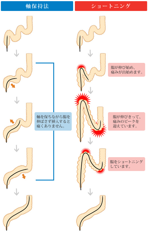 挿入法の説明図
