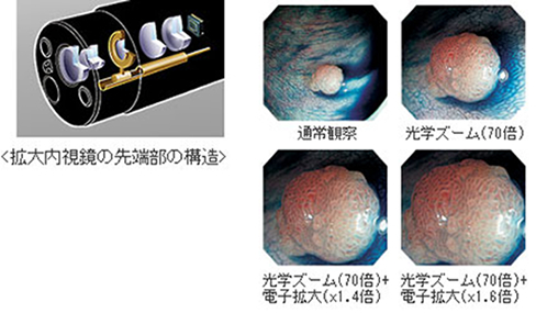 拡大内視鏡