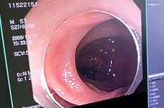 1.排便時、ペーパーに少量の血が付着するや血便など出血があるとき